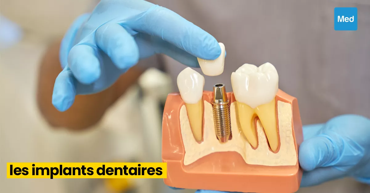 Les implants dentaires : Une solution durable pour retrouver votre sourire
